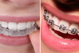 Braces & Aligners