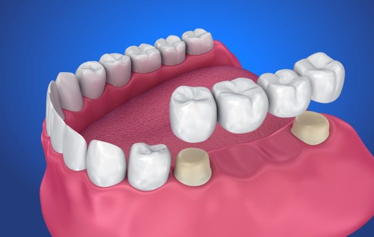 Zirconia Crowns