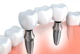 Dental Implants